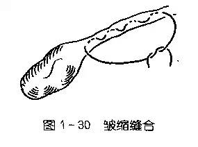 图文并茂为您详解各种外科缝合法