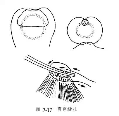 5,贯穿缝合法(两种8字缝合法)由两个间断缝合组成,缝扎牢固省时,如