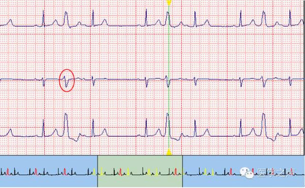 每天学看一份心电图第10期