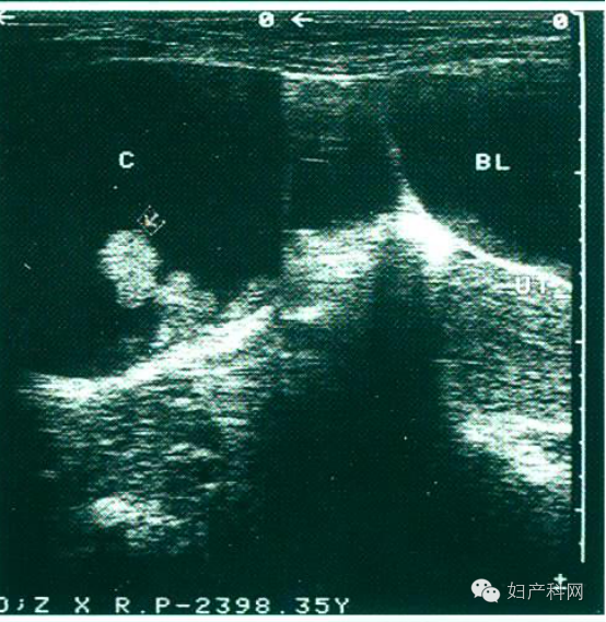 【超声笔记】no.16阴道超声的检查方法及操作要点解读