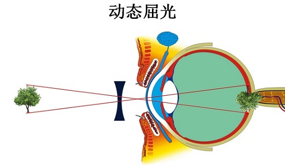 视光师针对这款智能眼镜矫正近视的原理做了详细的讲解,云 智能眼镜