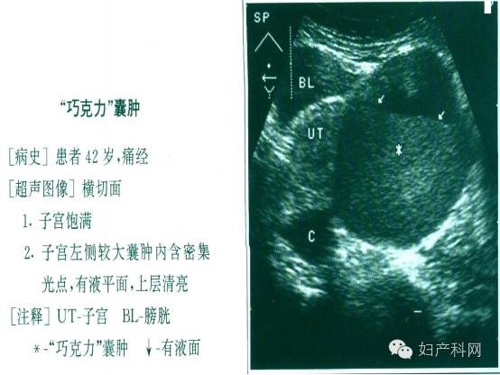 囊肿) 临床表现:痛经,性交痛,不孕 声像图: 大多数位于宫颈和陶氏腔