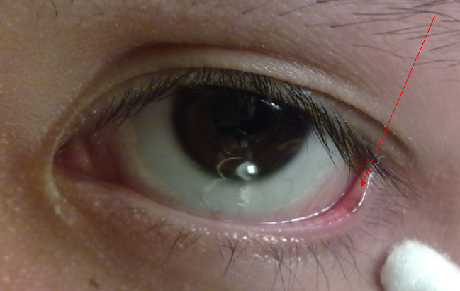 眼部疾病需关注,眼部疾病9大疾病信号大解析
