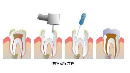 牙髓炎根管治疗全过程解析
