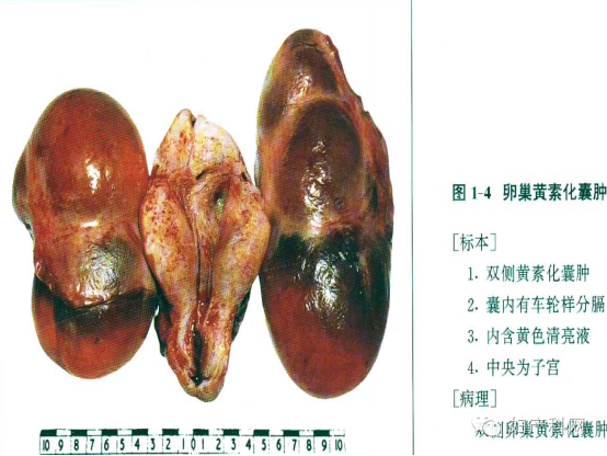 健康 正文  滤泡囊肿,黄体囊肿,卵泡膜-黄素囊肿等 临床表现: 一般