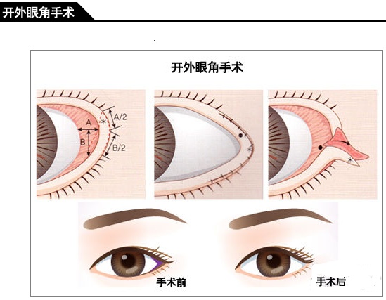 科普详细解释开目眦眼角