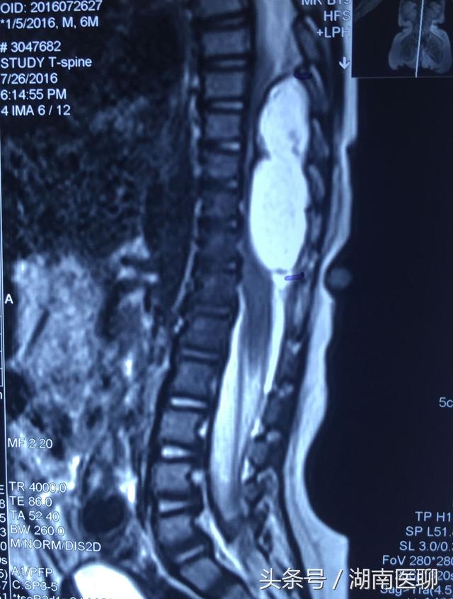 【恺恺椎管内的肿瘤(白色条状部分)长达5个椎体截段.】
