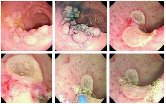 讲真这五种内镜下肠息肉治疗技术你懂吗
