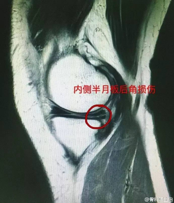 半月板后角损伤伴膝关节大量积液的影像表现!