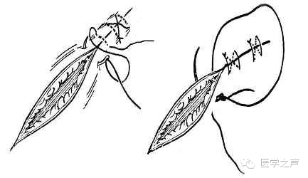 图文并茂为您详解各种外科缝合法!