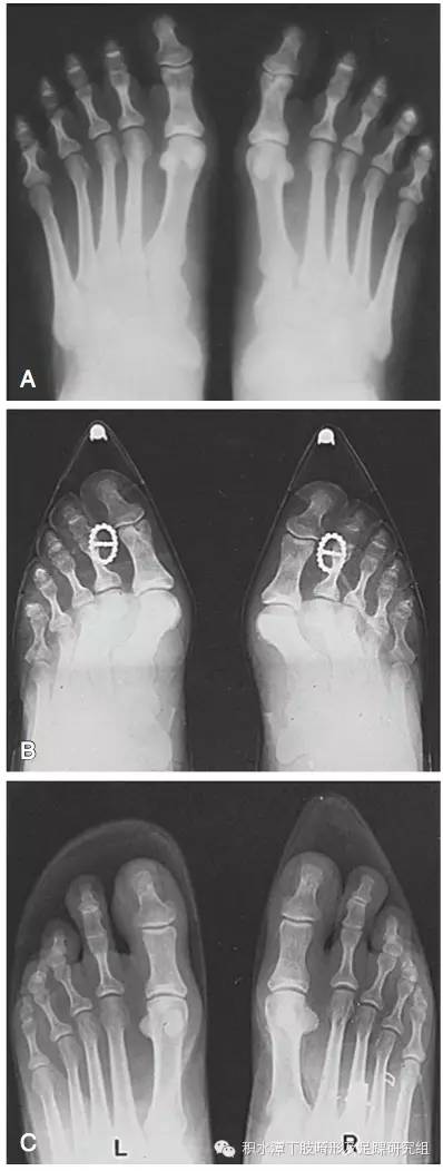 韧带组织的松弛,关节半脱位,而且高跟鞋还会加重大脚趾的籽骨的脱位