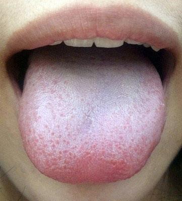 正常人的舌苔白色,薄而均匀的平铺在舌面,在舌面中部以及