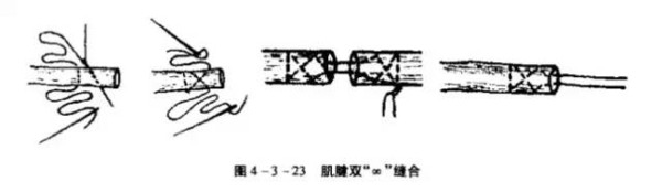 图文并茂为您详解各种外科缝合法