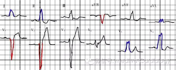 侃侃心电图上的那些胖子们