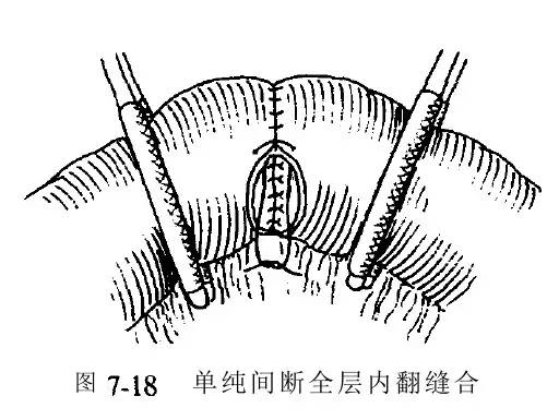 图文并茂为您详解各种外科缝合法