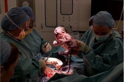 剖腹产宝宝从妈妈肚子里出来的瞬间,一起见证生命