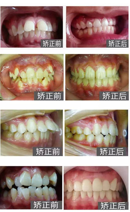 【新增108名额】孩子龅牙,畸形牙,丑牙,报名来领矫牙