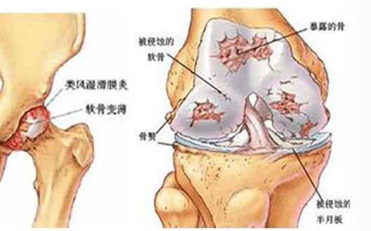 膝盖滑膜炎用哪种治疗方法效果最好