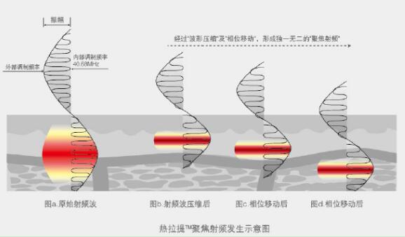 热拉提的原理_抗衰紧肤美容仪器好用吗 绿美涵 惠州抗衰紧肤美容仪器(2)