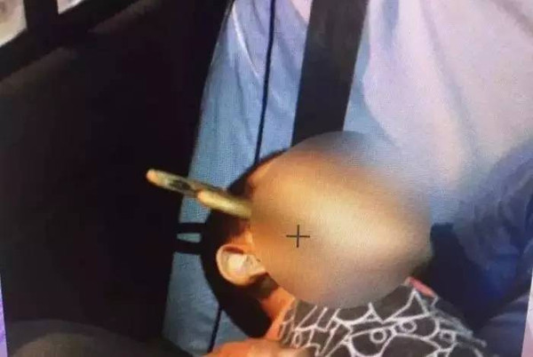哈尔滨6岁男孩被剪刀扎入太阳穴!受伤后男孩第