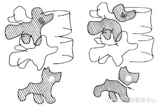 图文详解椎弓峡部裂
