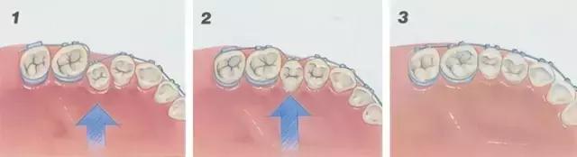 正畸后,牙齿易松动,掉落吗?