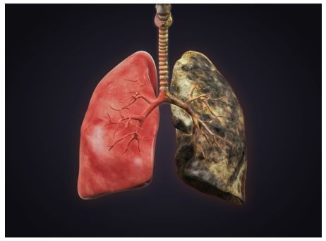 健康的肺与堆积毒素的肺