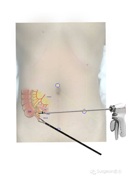 图文示教|腹腔镜阑尾切除术