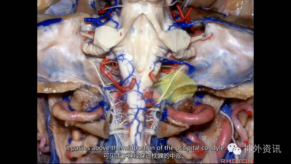 远外侧入路与颈静脉孔|therhotoncollection系列解剖视频
