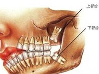 智齿一定要拔掉吗