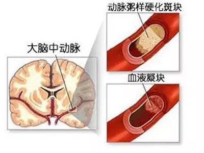 脑梗死、脑血栓及脑出血的区别