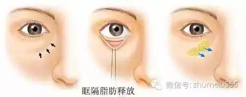 眶隔脂肪释放去眼袋:让你同时告别眼袋和泪沟