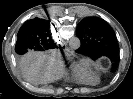 专家谈CT引导下经皮肺穿刺活检