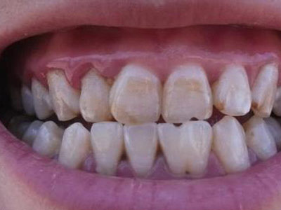 牙齿黄黑的原因有哪些