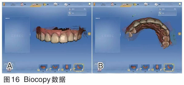 瓷贴面修复数字化印模技术实例分析