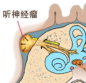 眩晕耳鸣不可忽视听神经瘤可能