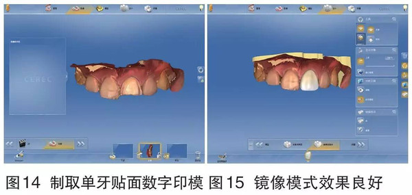 瓷贴面修复数字化印模技术实例分析