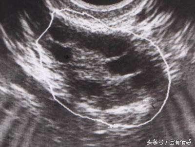 15岁查出多囊卵巢综合症,自然受孕成功一次生