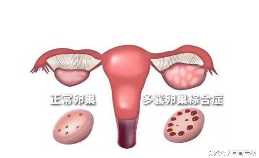 15岁查出多囊卵巢综合症,自然受孕成功一次生