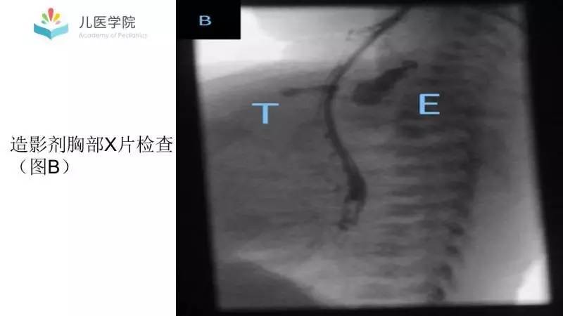 第47期答案丨食管气管瘘病例报道一例及分型