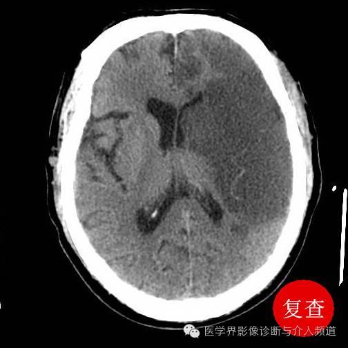 超急性期脑梗塞CT征象