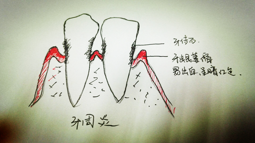如果牙齿表面的牙菌斑没有及时清理,牙龈边缘会发炎,肿胀,经治疗可