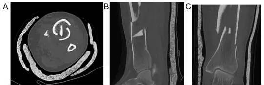 轴位(a),矢状位(b),冠状位(c)提示胫骨近端粉碎性骨折和髓腔内