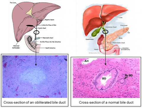 胆道闭锁的症状 和病理切片 (图片来源:the canadian biliary