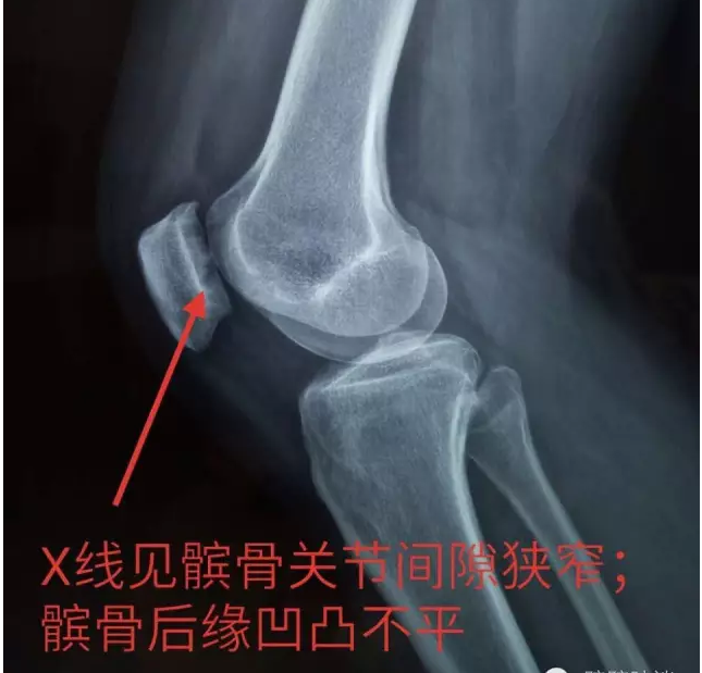 科普:不可轻视的膝关节运动损伤髌骨软化症