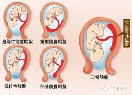 怀孕晚期的阴道出血要考虑前置胎盘