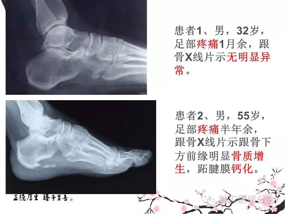 小针刀治疗跟骨痛