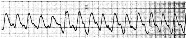 每天学看一份心电图(第22期)室扑和室颤