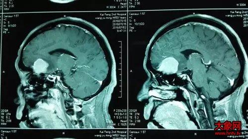 开封市第二人民医院首例颅底肿瘤手术