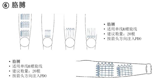 蛋白线提升的原理_蛋白线面部提升术的工作原理是什么